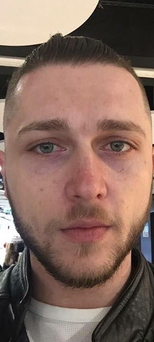 After image of an OPATRA LED Dermisonic Therapy session