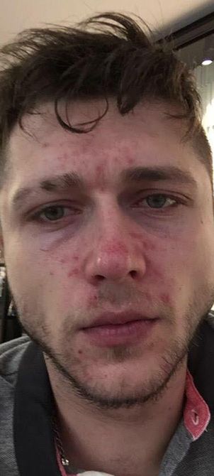 Before image of an OPATRA LED Dermisonic Therapy session