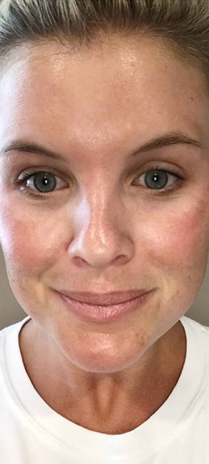 Before image of a Dermapen Microneedling session